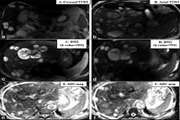 شناسایی و کاراکتریزاسیون ضایعات فوکال کبدی با MRI استاندارد بدون تزریق و دیفیوزیون MRI در بیماران مراجعه کننده به  مرکز تصویر برداری بیمارستان امام خمینی (ره): مقایسه با دینامیک MRI